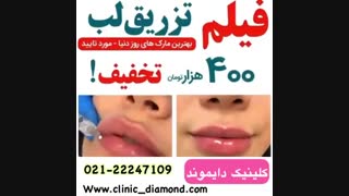 400 هزار تومان تخفیف برای تزریق ژل لب
