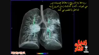 ریه های یک کرونایی