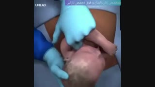 عمل سزارین