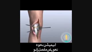 انیمیشن جراحی تعویض مفصل زانو