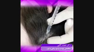 مزوتراپی موی سر اندودنتیکس