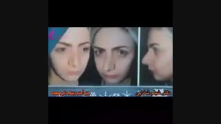 فیلم عمل جراحی بینی ترمیمی (قسمت سوم)