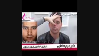 فیلم نتیجه عمل جراحی بینی بعد از 1 سال و 9 ماه (قسمت دوم)