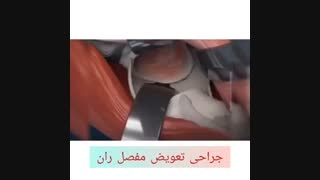 جراحی تعویض مفصل ران