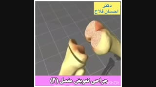 فیلم جراحی تعویض مفصل