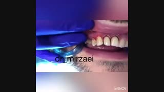 جراحی و‌ لیفت لثه بدون درد تزریق ژل