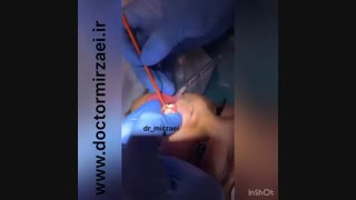 زیباسازی دندان های شیری کودکان