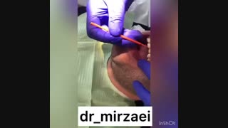 مراحل گذاشتن کامپوزیت