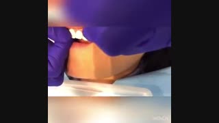 فیلم گذاشتن لمینت