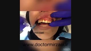 نمونه لیفت لثه بدون درد