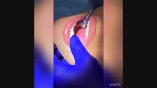 نمونه جراحی لثه دندان پیش