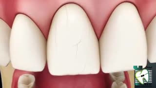 خطوط عمودی که در دندانهای جلویی | کلینیک دندانپزشکی ایده آل