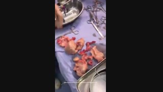 جراحی فیبروم 13 سانتی در یک خانم جوان