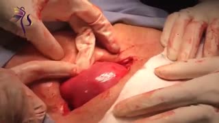 میومکتومی و درآوردن فیبروم های متعدد و حفظ رحم