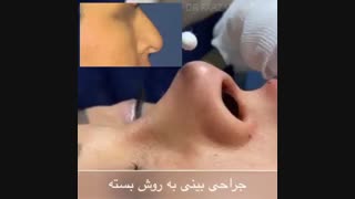 تزریق فیلر و تخلیه چربی لپ به همراه جراحی بینی ابرسانی پوست