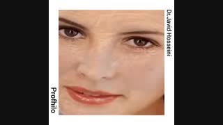 تزریق ژل پروفایلو