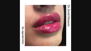 تزریق ژل لب