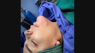جراحی بینی و تزریق چربی به چانه