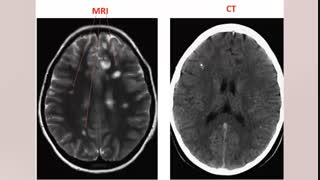تفسیر مقدماتی سی تی اسکن قفسه سینه و مبتلا به ویروس کرونا. CT SCAN