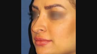 نمونه جراحی بینی ترمیمی