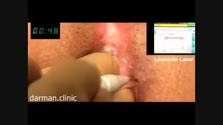 درمان بواسیر یا هموروئید با لیزر در درمان کلینیک