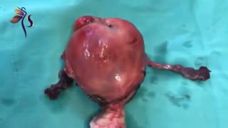 در آوردن رحم به علت خونریزی و فیبروم های متعدد