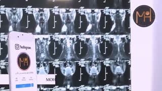 جوان 17 ساله با تورم گردن