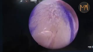 جراحی کم کردن حجم زبان