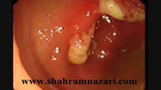 سندرم زخم منفرد راست روده بزرگ