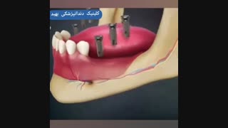 ایمپلنت برای شما مجاز نیست!!