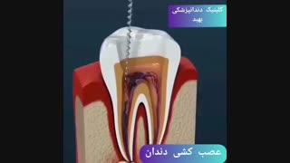 فیلم عصب کشی دندان