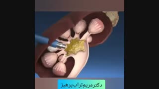روش نوین سنگ شکنی کلیه