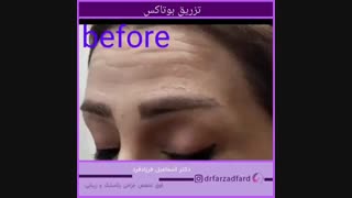 فیلم تزریق بوتاکس توسط دکتر اسماعیل فرزاد فرد پیلینگ شیمیایی
