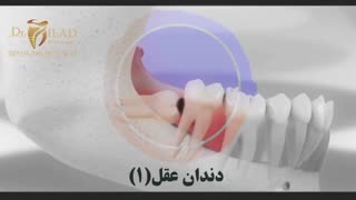 جراحی دندان عقل (بخش اول)
