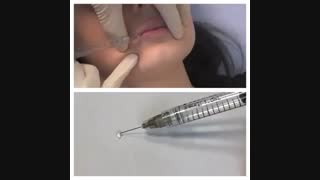 میزان ژل تزریقی در هر بار تزریق کلینیک دندانپزشکی