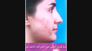 رضایه المریضه عن عملیه انحراف و تجمیل الانف