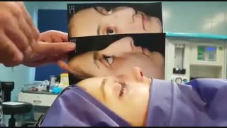 جراحی بینی استخوانی توسط دکتر امید ابراهیمی بهترین جراح بینی در تهران